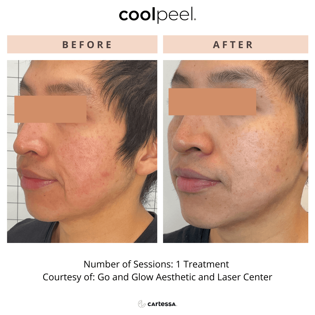 Before-and-after facial treatment photos showing reduced redness and acne marks.