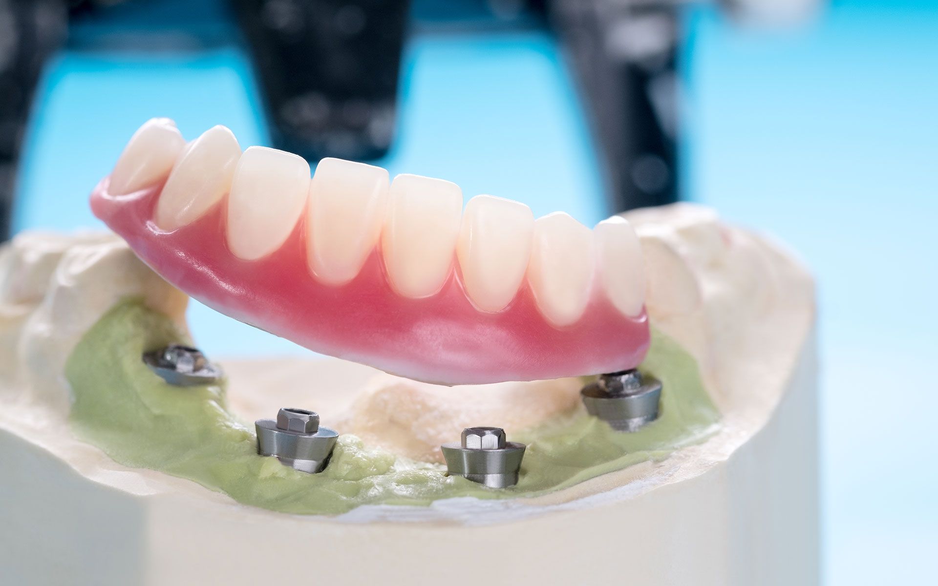 Dental implant model with a pink-colored prosthetic, teeth and gray implants on a blue background.