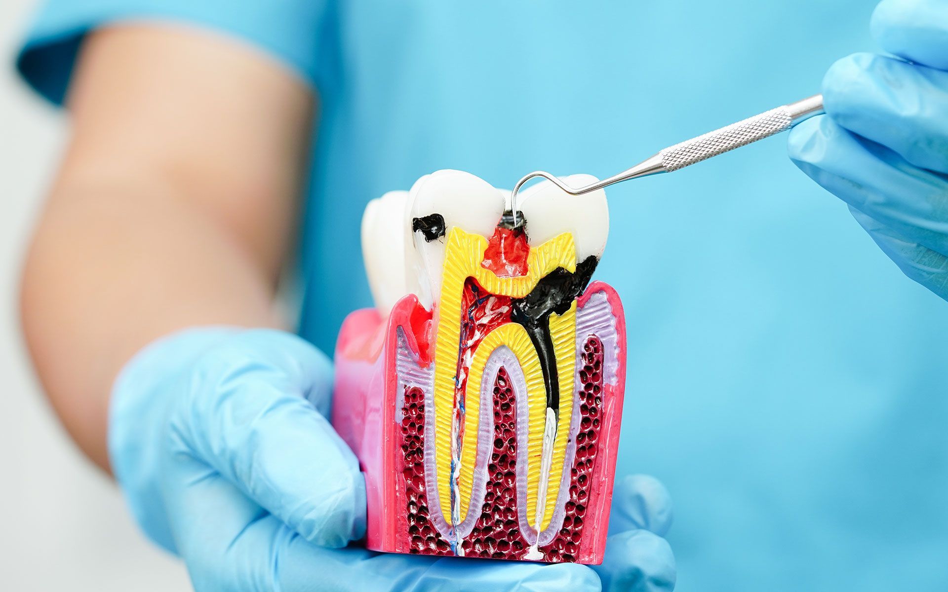 Dentist holding a cross-section tooth model, highlighting decay with a dental probe.