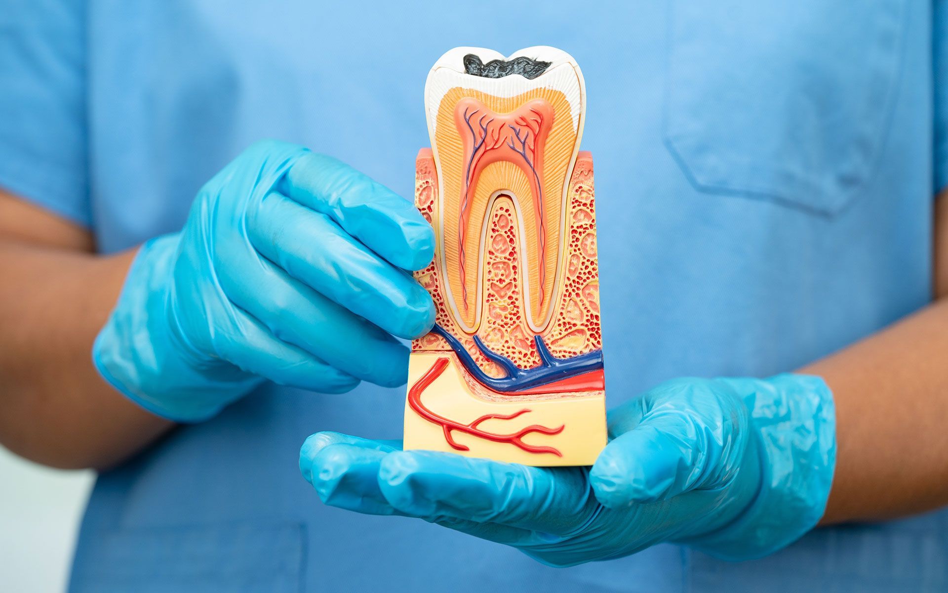 Dentist holding a cross-section model of a tooth, revealing decay, in blue gloves.