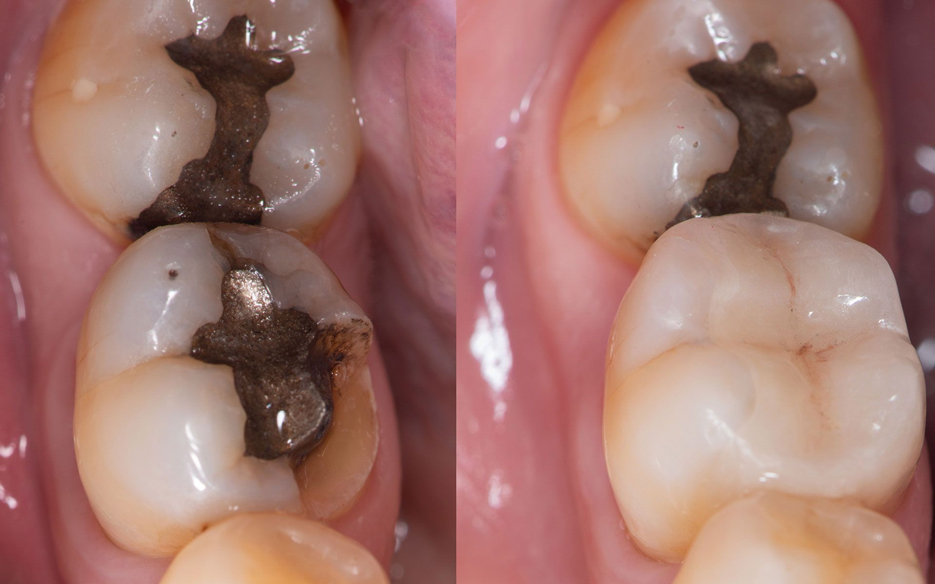 Two teeth, the lower one with a silver filling before and after a white composite filling.