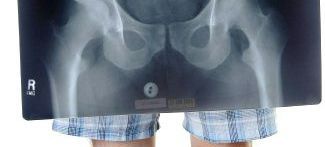 A person is holding an x-ray of their pelvis.