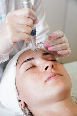 Woman receiving microneedling treatment on her forehead at a medical spa, with closed eyes.