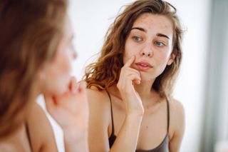 Woman with acne looking at her reflection in a mirror, touching her face.