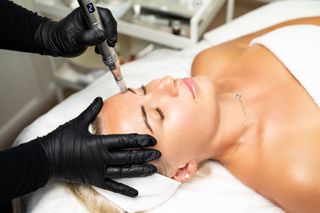 Woman receiving a microneedling facial. Esthetician in black gloves uses a device on her forehead.