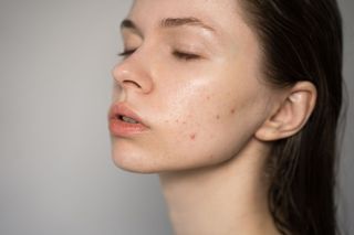 Woman with closed eyes and clear skin, showing signs of acne, lit by natural light.