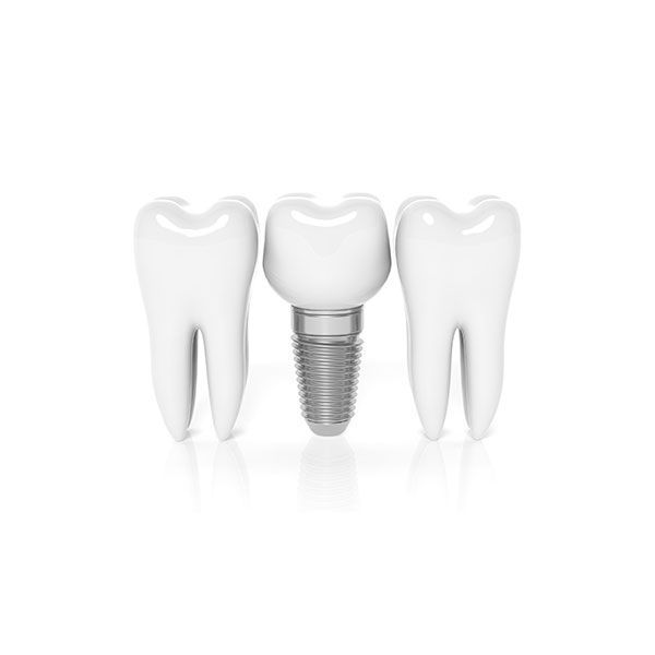 Dantų atkūrimas ant implantų