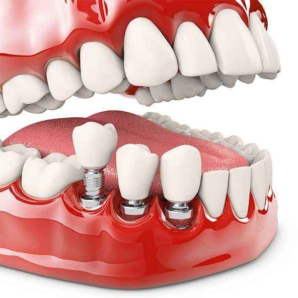 Vienmomentė dantų implantacija