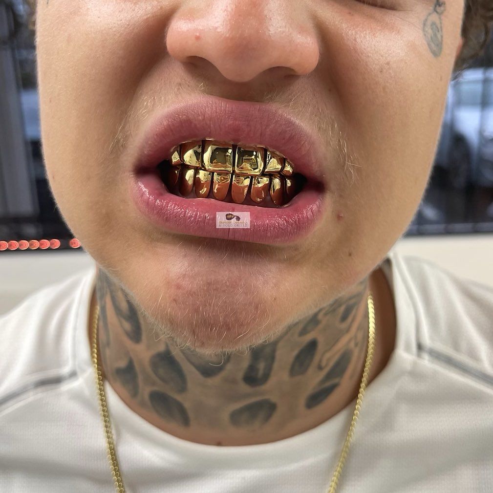 Customer showing permanent gold teeth grillz, full top and bottom set