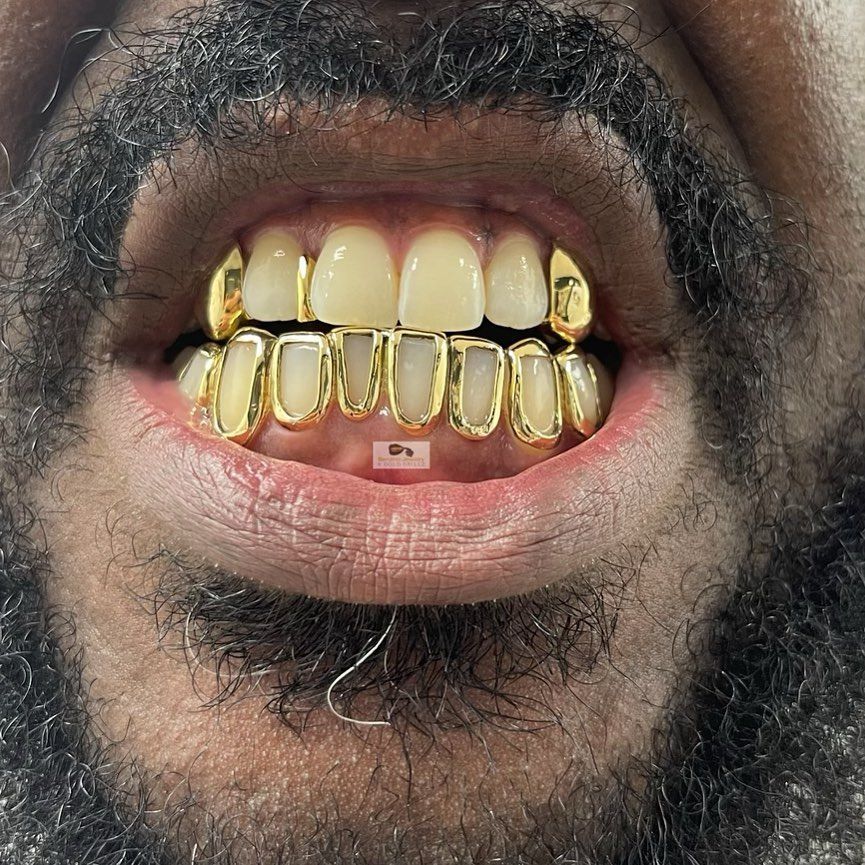 Closeup of teeth with gold fangs grillz and custom front cuff grillz
