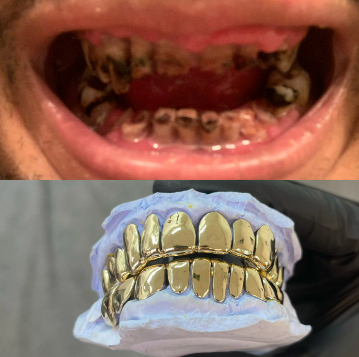 custom gold grillz 