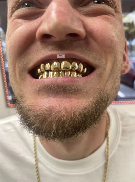 permanent gold teeth