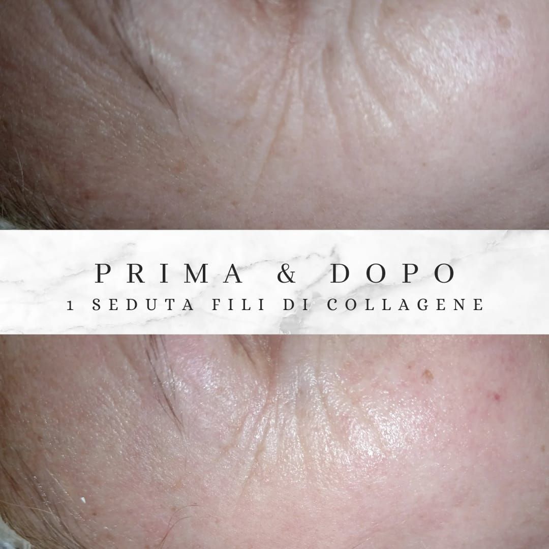 fili di collagene zampe di gallina