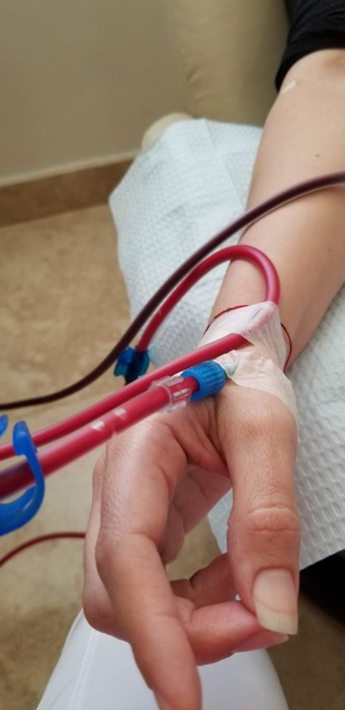 A person's arm with dialysis tubing connected to their wrist.