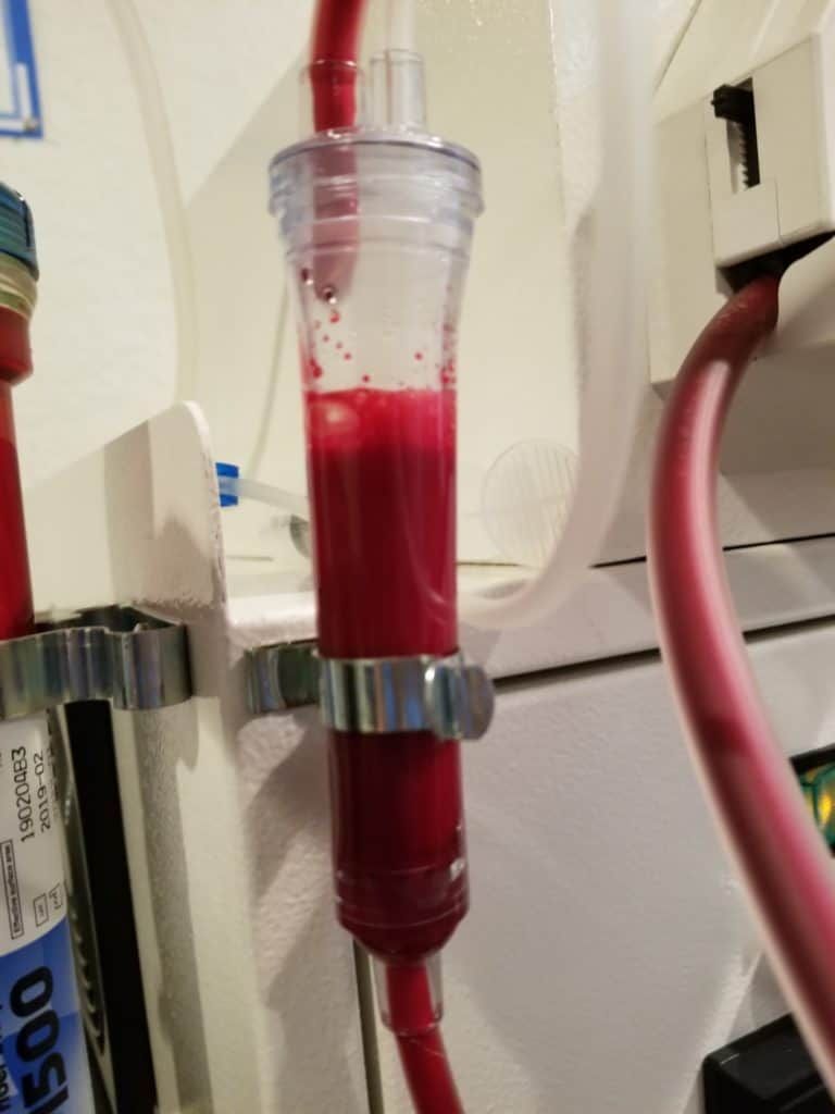 A clear, cylindrical blood filter with bright red blood. It is part of a medical machine with red tubing.