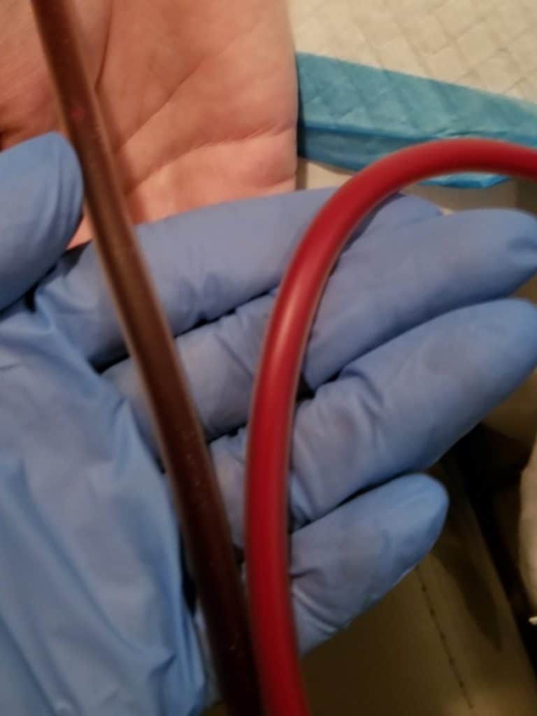 Gloved hand holding a dark brown and red medical tube.
