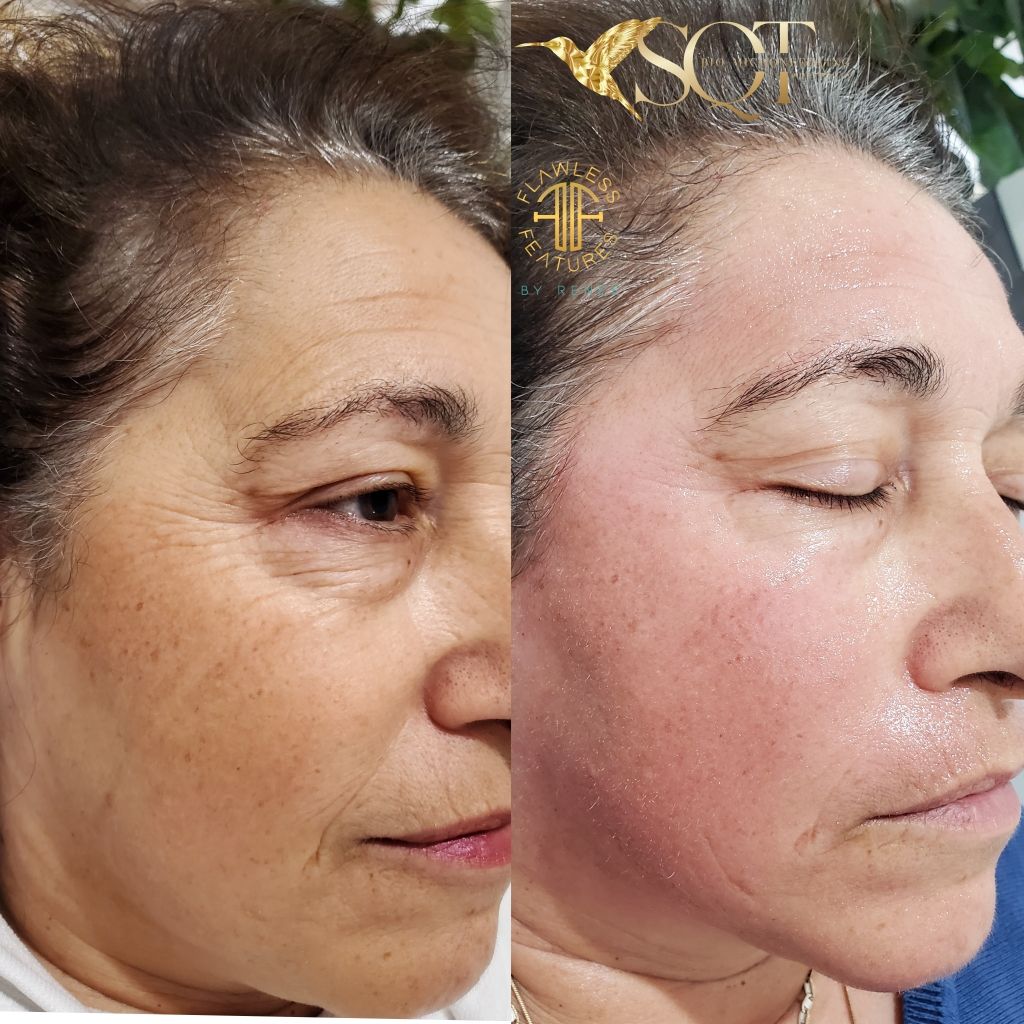 A Before and After Photo of a Woman Forehead — Organic Beauty by Kessie in Yeppoon, QLD