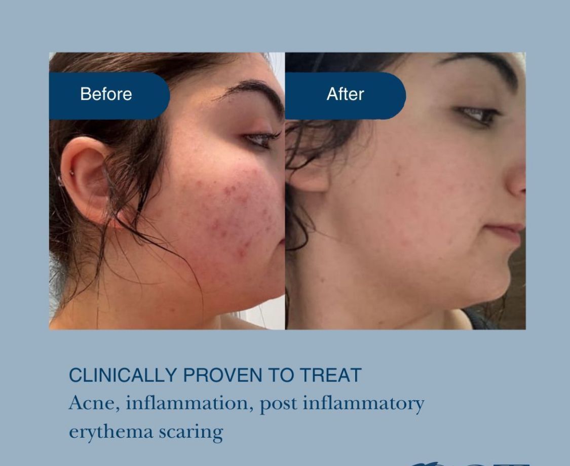 A Before and After Treatment Photo of a Woman's Side Face — Organic Beauty by Kessie in Yeppoon, QLD