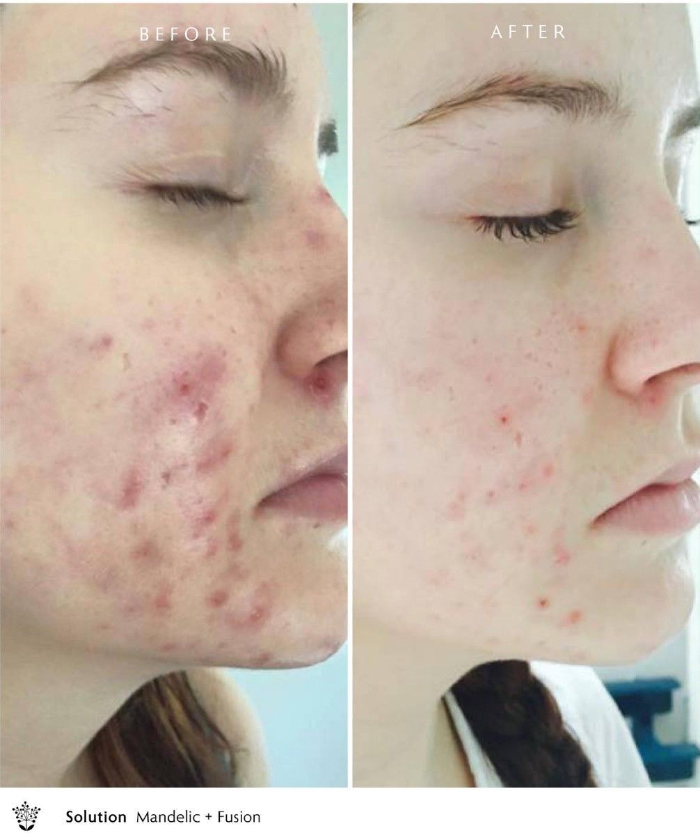 A Before and After Photo of a Woman's Face With Acne — Organic Beauty by Kessie in Yeppoon, QLD