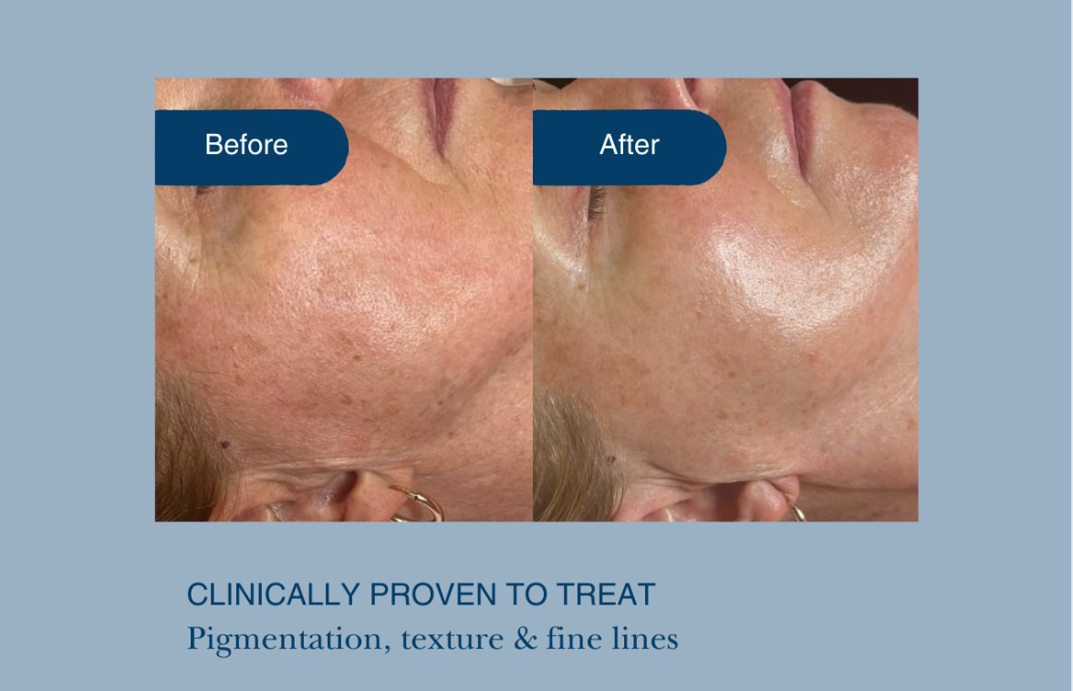A Before and After Photo of a Woman's Face — Organic Beauty by Kessie in Yeppoon, QLD