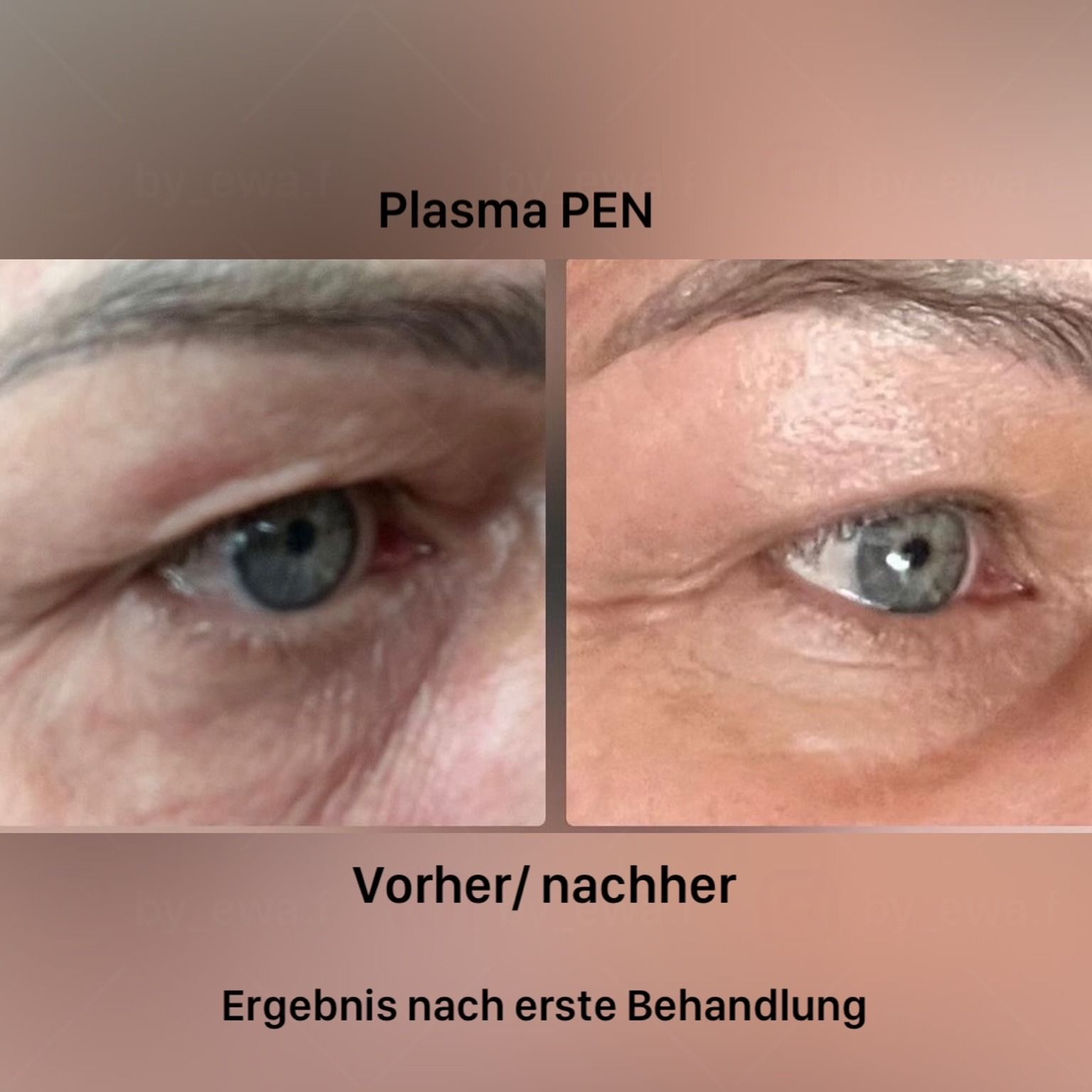 Die Augen einer Frau vor und nach einer Plasma-Pen-Behandlung