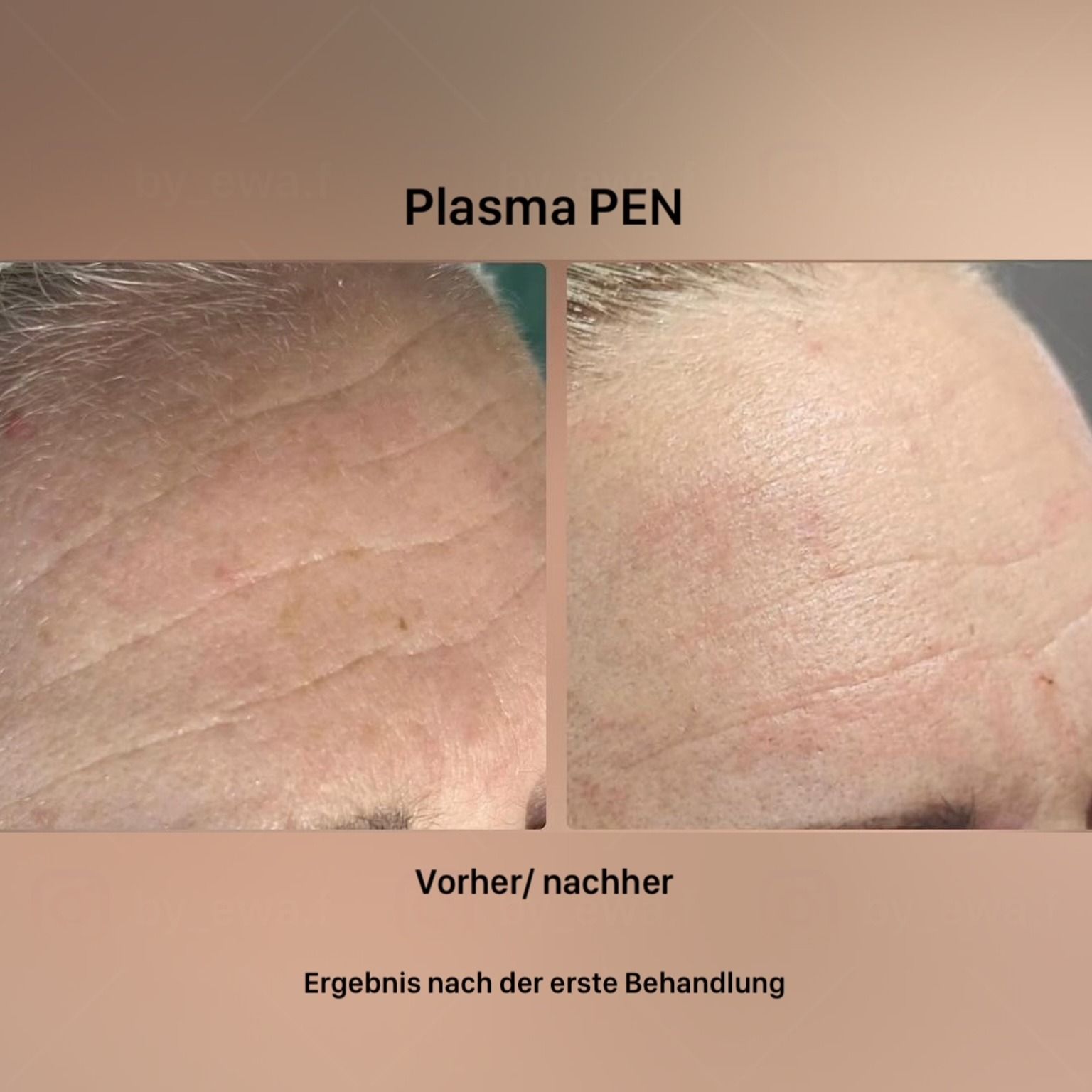 Ein Vorher-Nachher-Foto der Stirn einer Frau