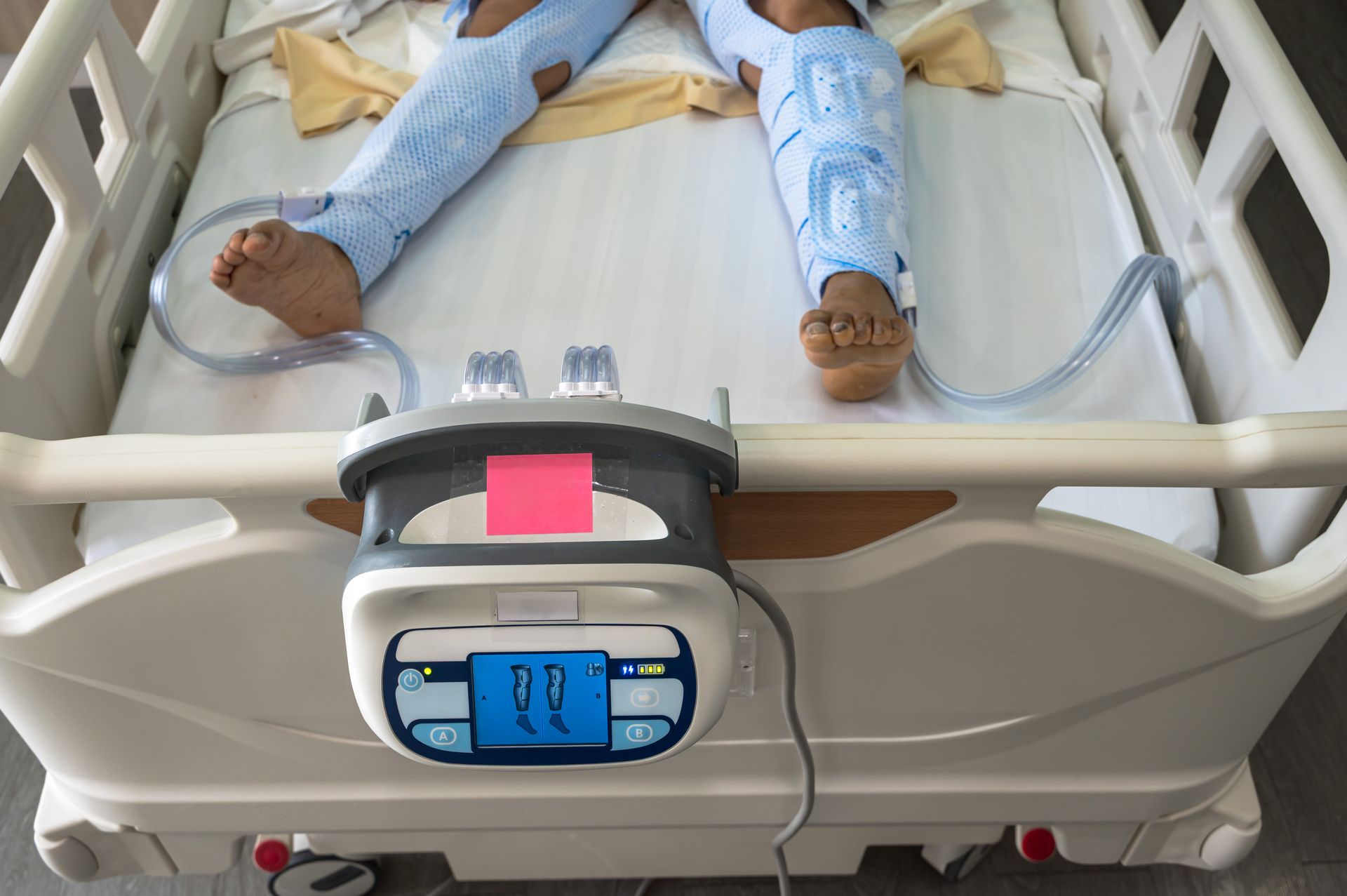 Patient lying in a hospital bed with sequential compression devices on both legs connected to a control unit.