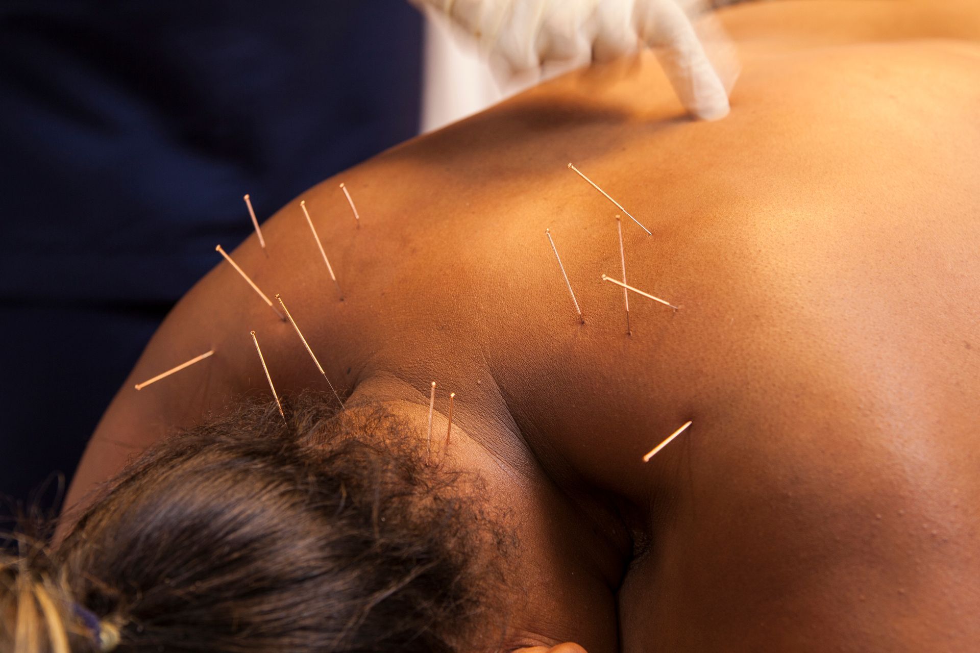 Close-up of a person's back with acupuncture needles inserted; a gloved hand points to the skin.