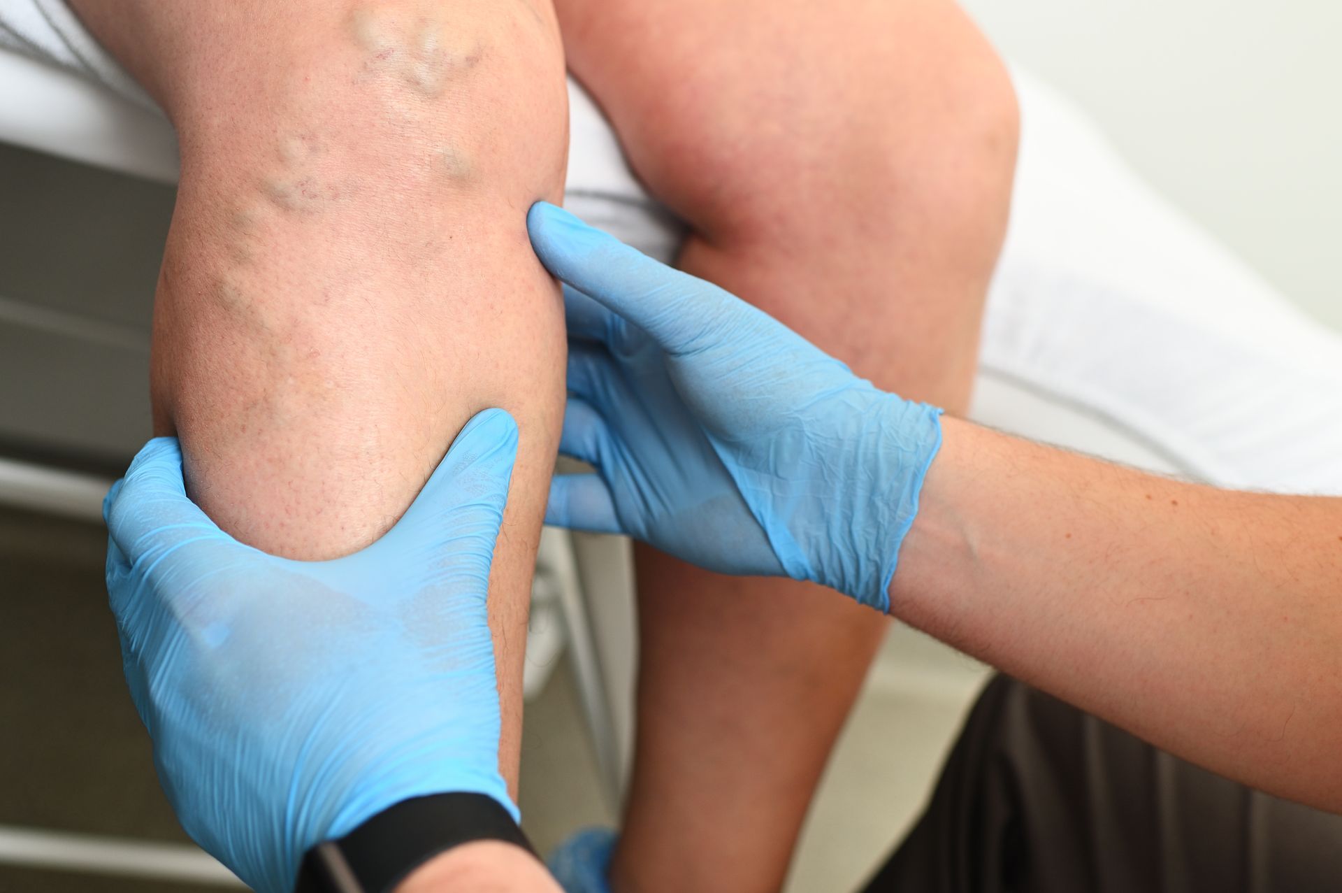 A medical professional in blue gloves examines a leg with visible varicose veins.