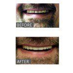 before and after picture of more straight and white teeth