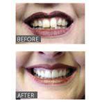 crooked teeth before cosmetic dental treatment