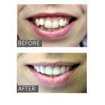 smile with perfectly aligned teeth