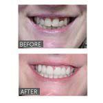 before and after picture of cosmetic dentistry