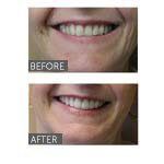 the effects of teeth whitening services