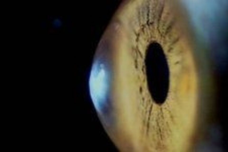 Trattamento del cheratocono