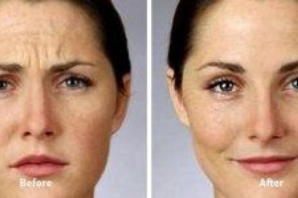 Infiltrazioni antirughe