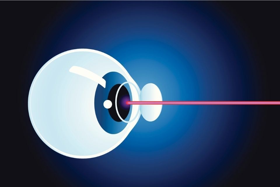 tecniche di chirurgia refrattiva