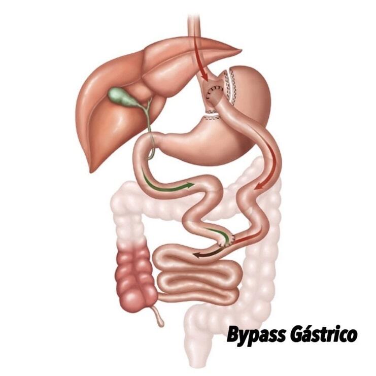 DR. MANUEL VALLEJO SOTO. FACS. AGAF. - BYPASS GÁSTRICO DR. MANUEL VALLEJO SOTO. FACS. AGAF. - BYPASS GÁSTRICO