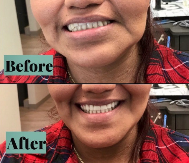 Side-by-side comparison: woman's smile with crooked teeth 