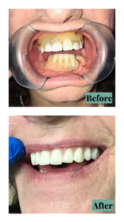 Before and after dental work: yellow teeth before, white smile after.