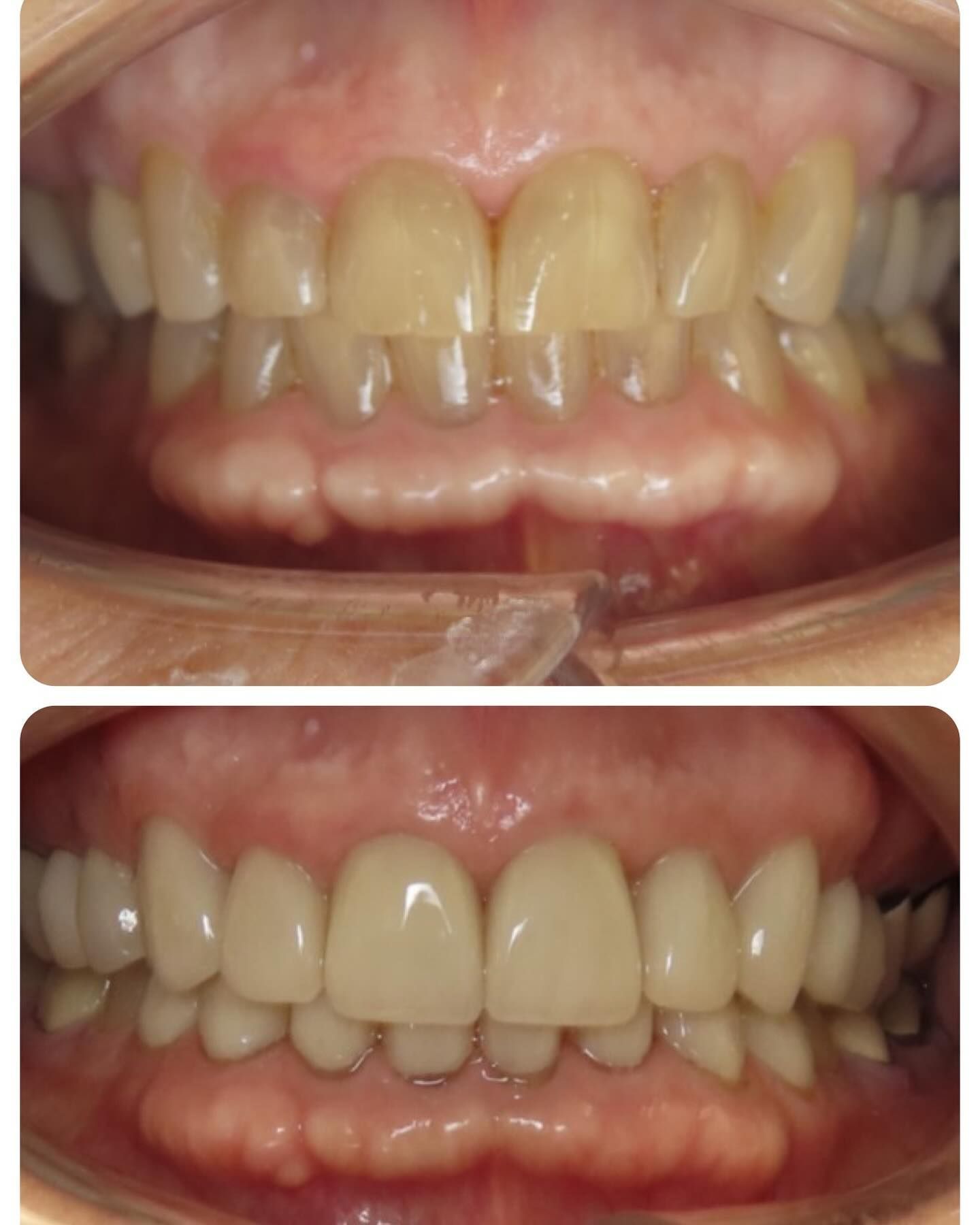 A before and after picture of a person 's teeth