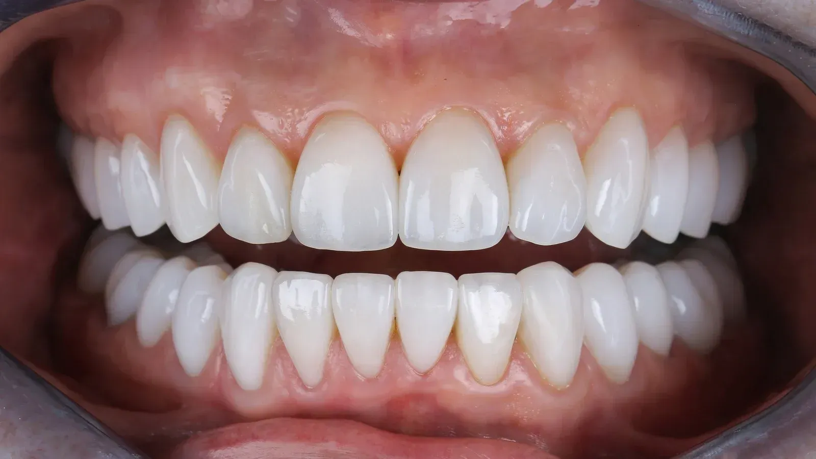 A close up of a person 's teeth with white teeth.