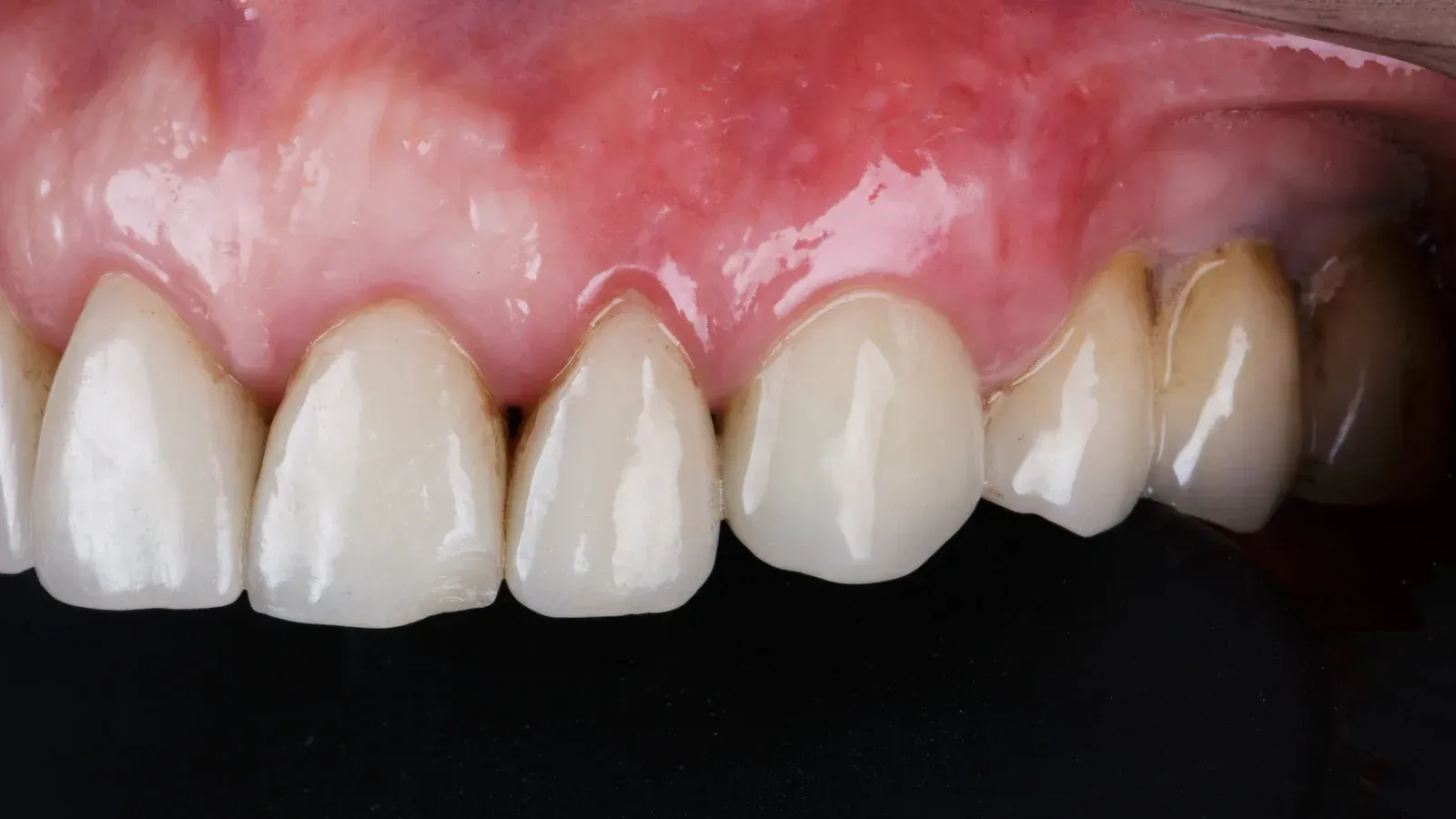 A close up of a person 's teeth with a black background.