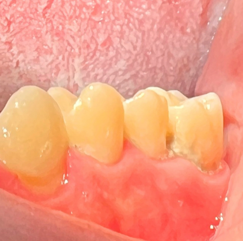 Before Full Mouth Rehabilitation