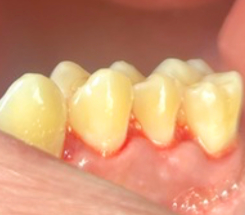 After Full Mouth Rehabilitation