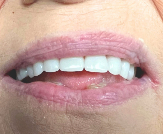 After Teeth Restoration