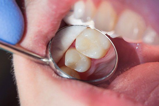 Empastes, incrustaciones y recubrimientos del color de los dientes en Cicero, IL