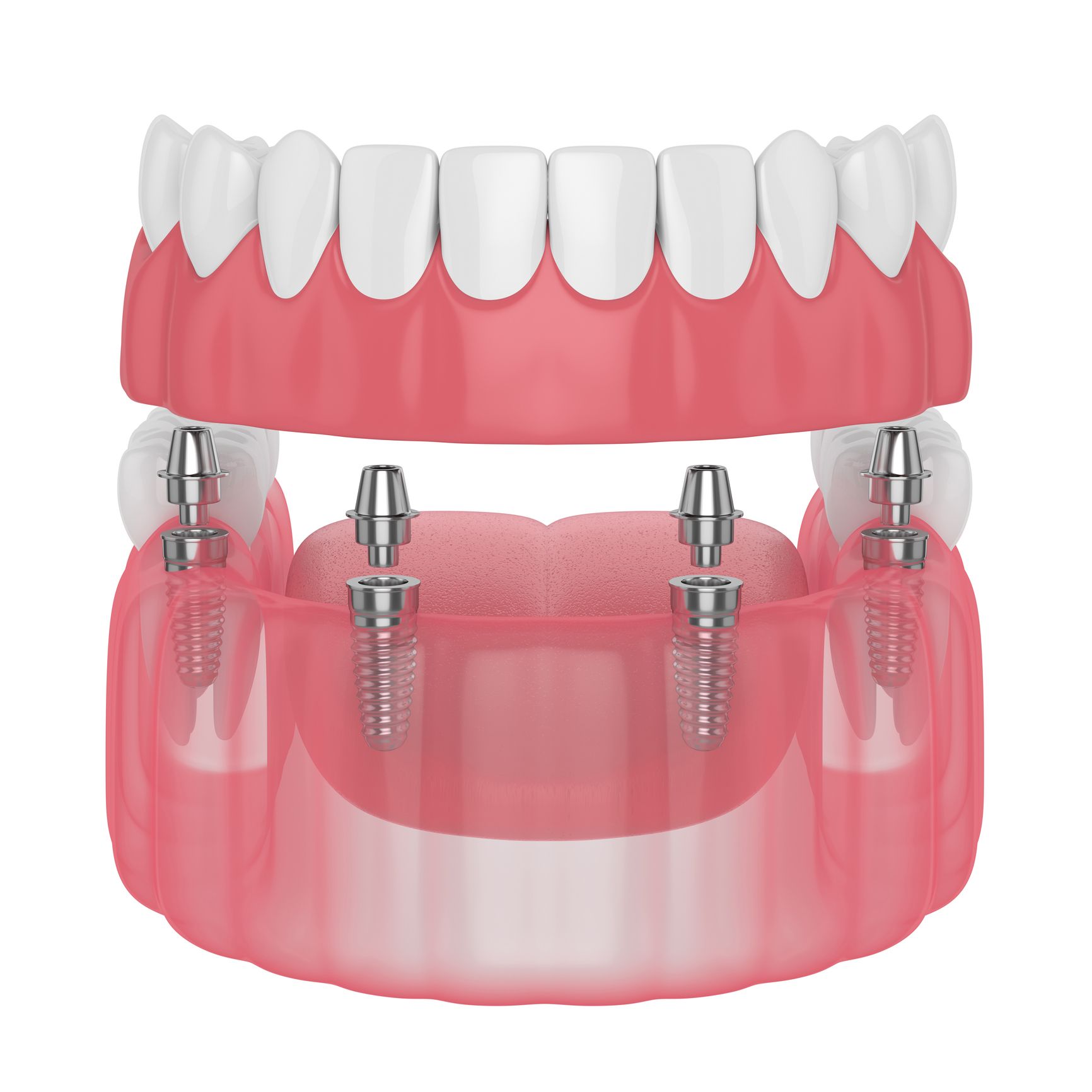 dental implant