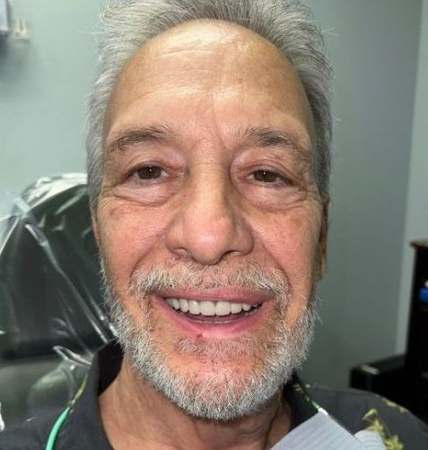 After Dentures