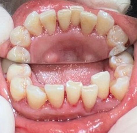 After Teeth Cleaning